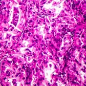 Summit Therapeutics hits possible snag on lung cancer drug seen as a blockbuster